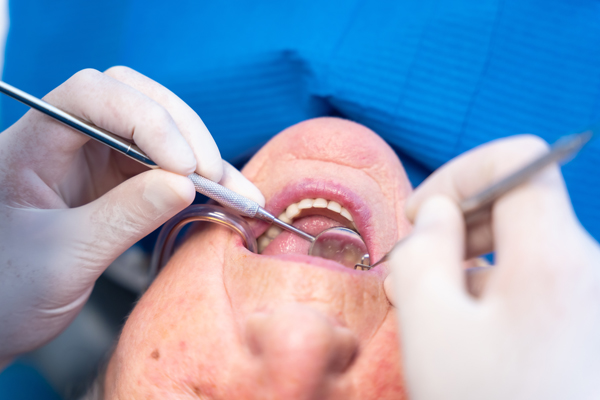 Reasons To Choose A Composite Filling Over A Silver Filling