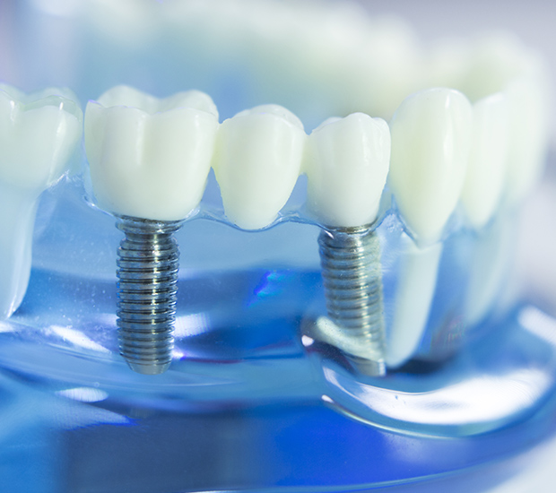 Tyler Dental Implants