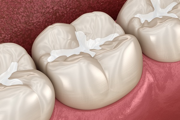 What Are Dental Sealants For Teeth?