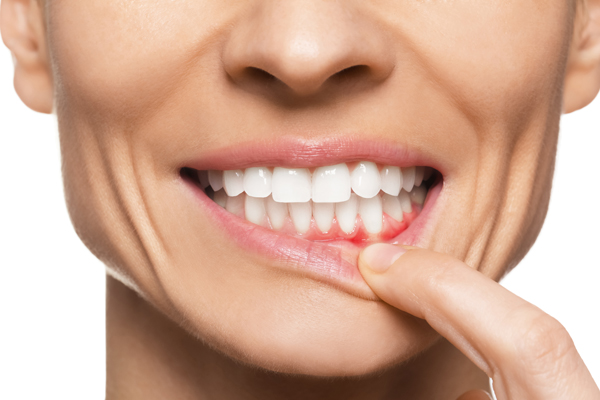 Can You Reverse Gum Disease At Home?