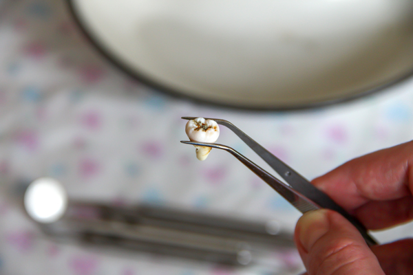 How To Reduce The Risk Of Dry Socket After A Tooth Extraction